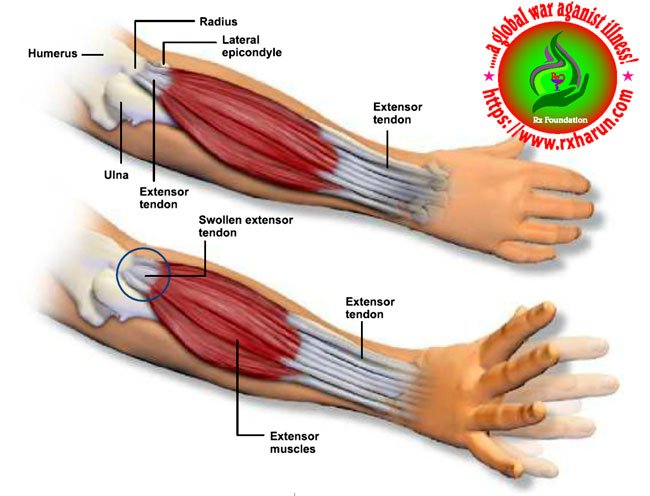 Tennis Elbow Causes, Symptoms, Treatment