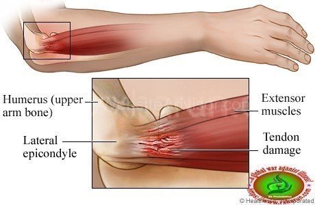 Tennis Elbow Causes, Symptoms, Treatment