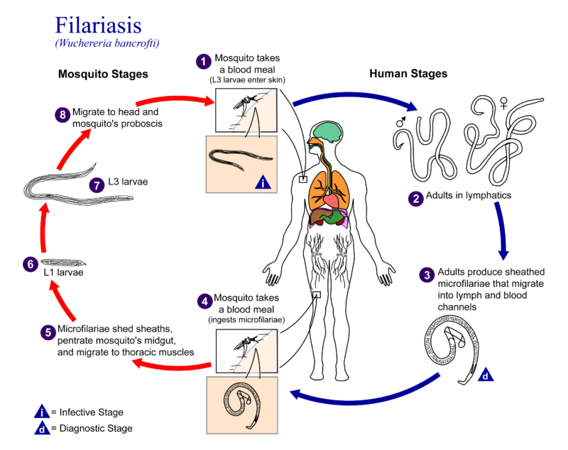 Filarial Elephantiasis; Symptoms, Diagnosis, Treatment Filarial Elephantiasis; Symptoms, Diagnosis, Treatment