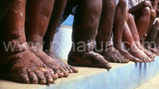 Filarial Elephantiasis; Symptoms, Diagnosis, Treatment Filarial Elephantiasis; Symptoms, Diagnosis, Treatment
