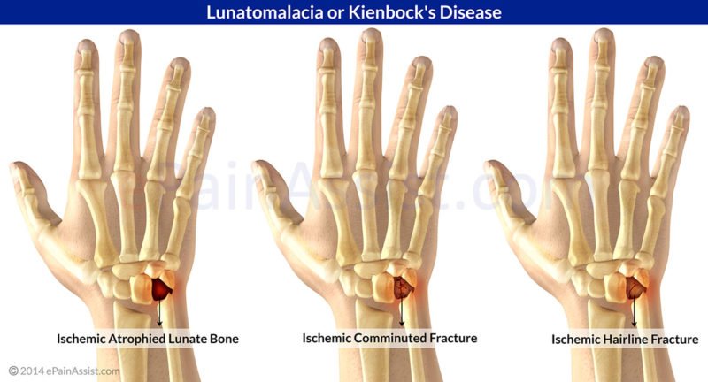 Avascular Necrosis of the Lunate - Symptoms, Treatment Avascular Necrosis of the Lunate - Symptoms, Treatment