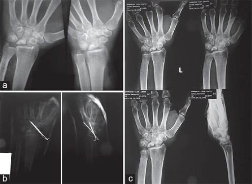 Avascular Necrosis of the Lunate - Symptoms, Treatment Avascular Necrosis of the Lunate - Symptoms, Treatment