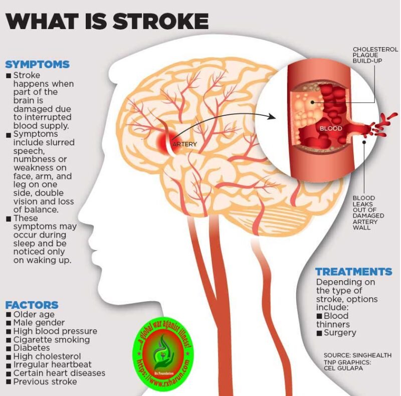 stroke